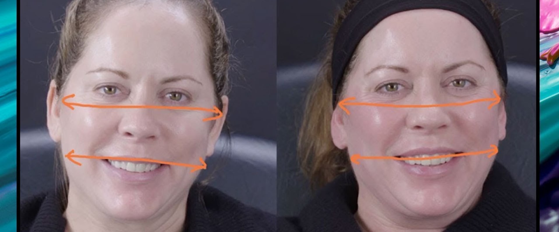 Do Fillers Change the Look of Your Face?