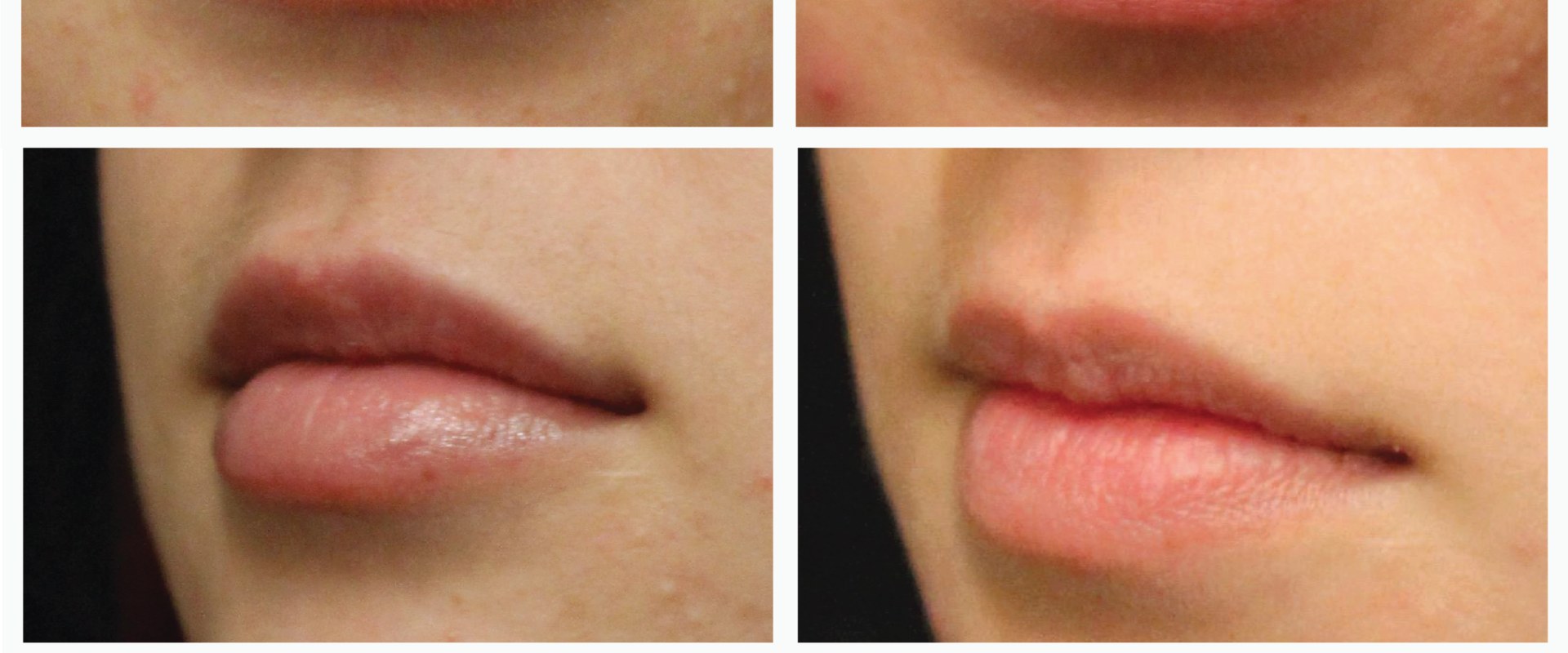 Do Lip Fillers Go Down After the First Day?