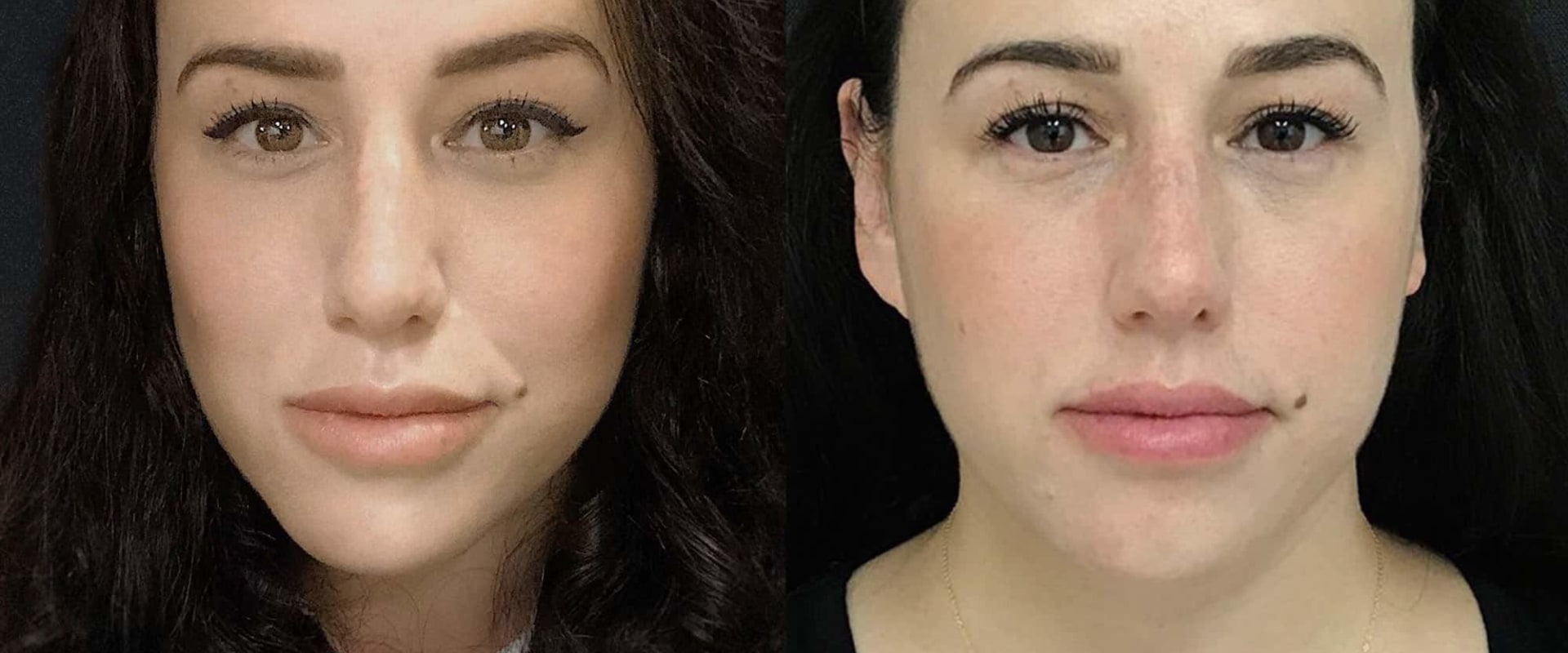 What is the Best Filler for Cheeks and Lips?
