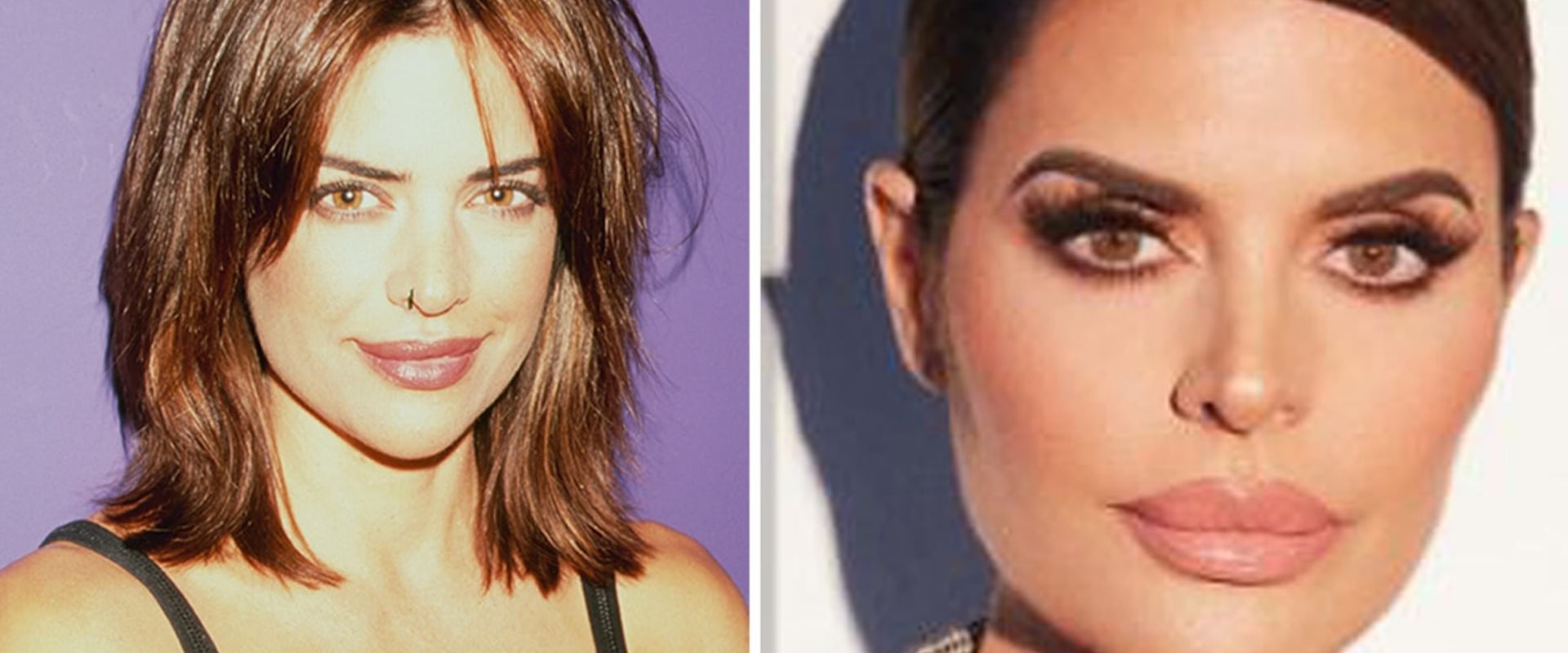 Lip Fillers: A History from the 80s to Now