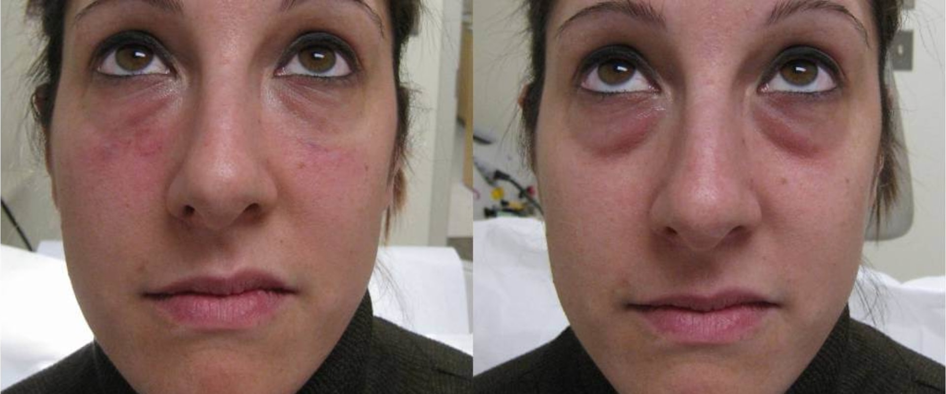 What Do Dermal Fillers Do to Your Face?