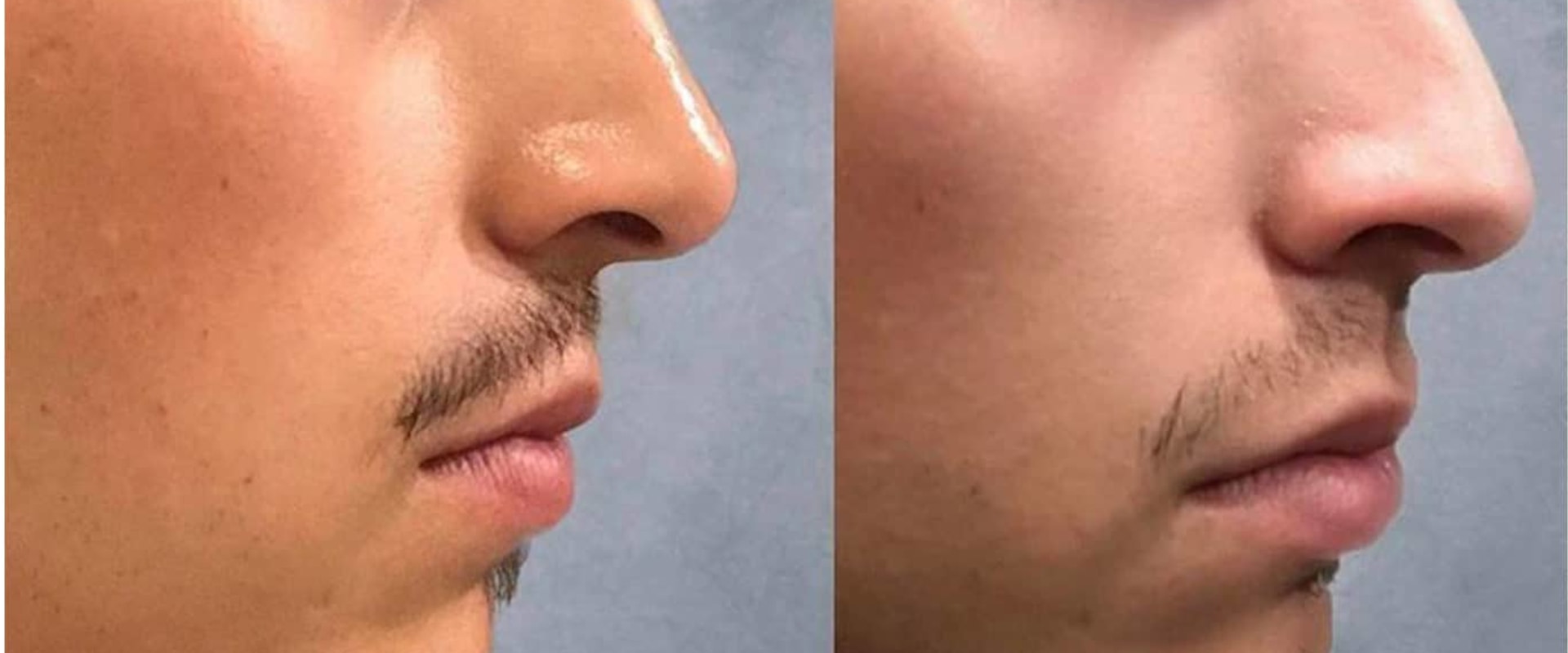 Can Dermal Fillers Last Forever?