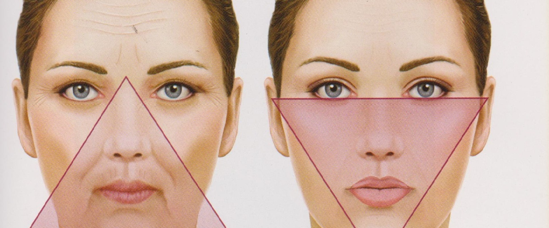 Where Should Cheek Fillers Go? A Comprehensive Guide
