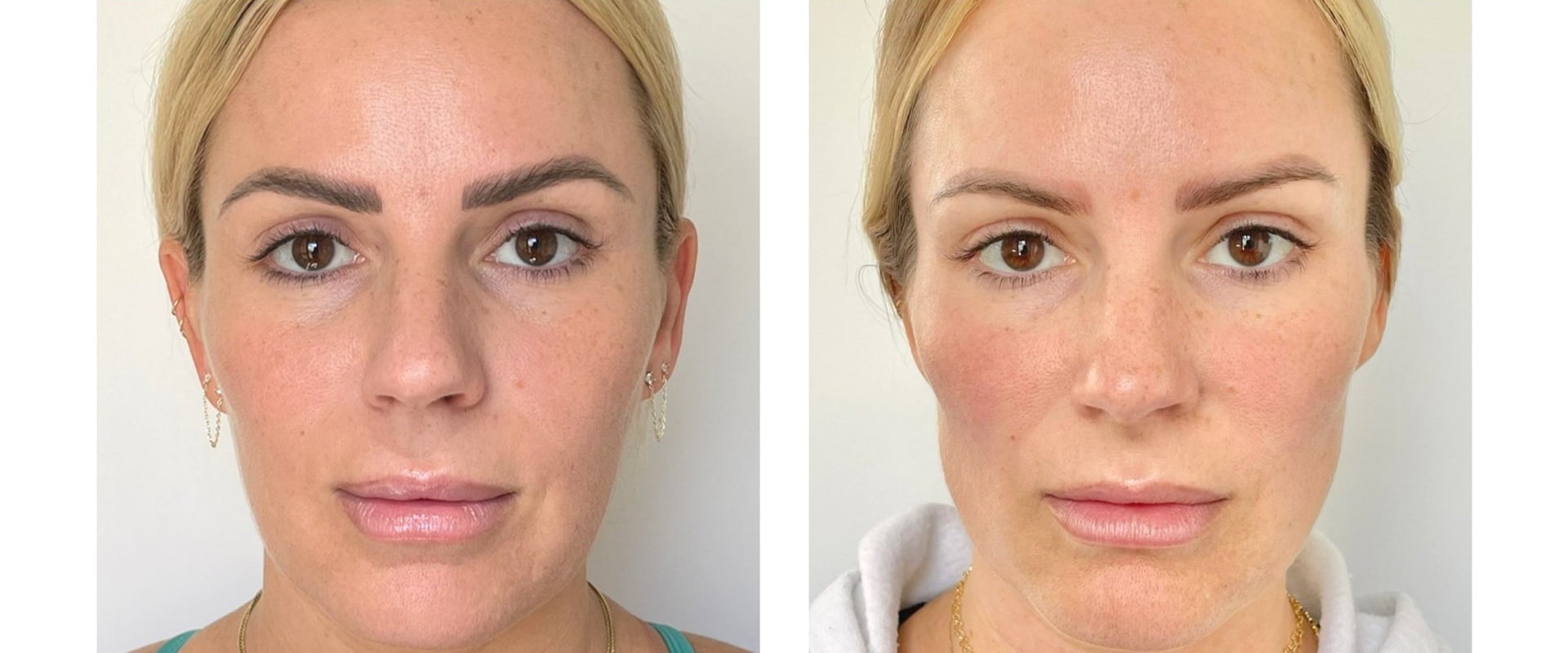 The Best Natural Fillers for a Youthful Look