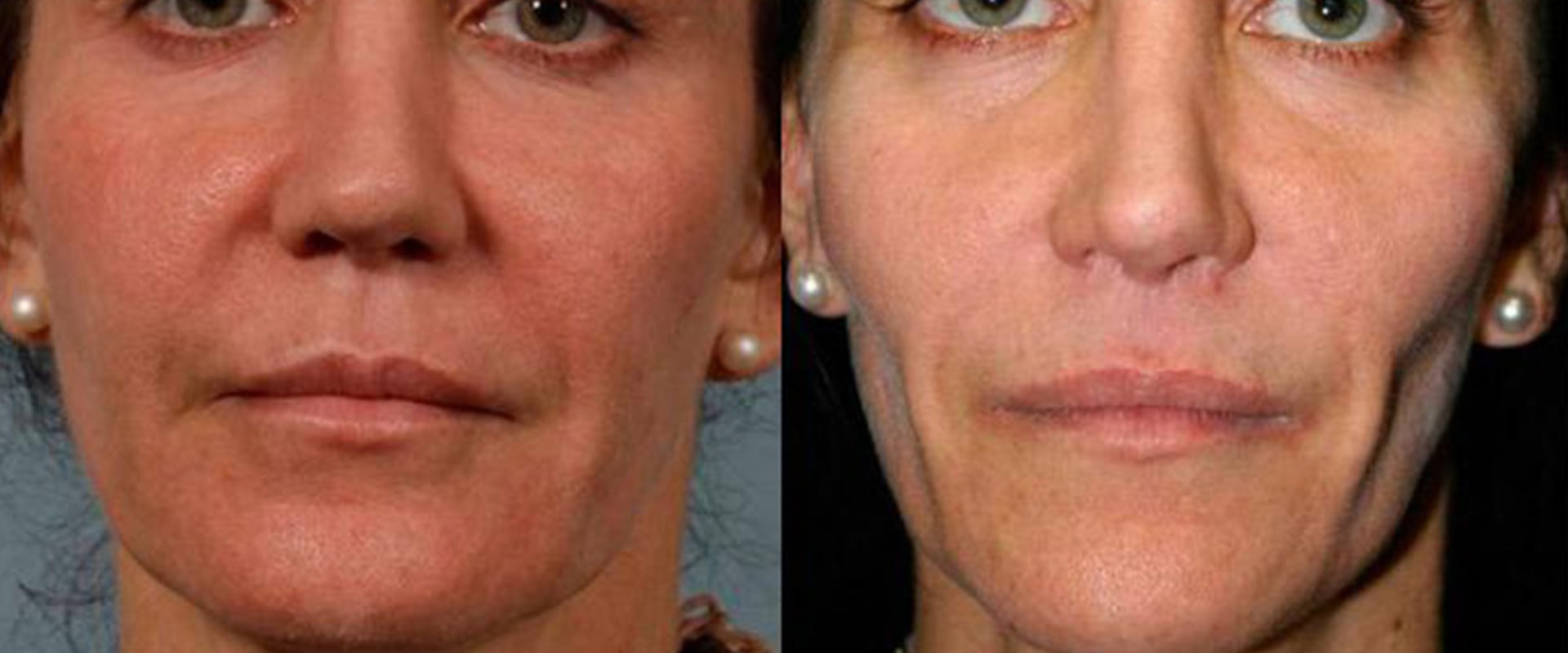 How Long Does It Take for Facial Fillers to Work?