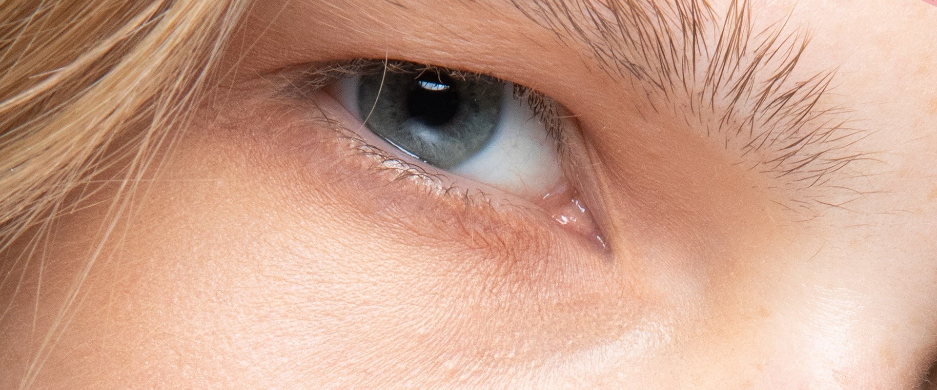Do Fillers Make Wrinkles Worse?