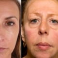 Can Fillers Make You Look Older?