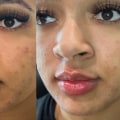 Curated Medical: The Home Of High-Quality Facial Fillers