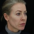 How Much Filler is Needed to Enhance Hollow Cheeks?