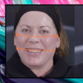 Do Fillers Change the Look of Your Face?