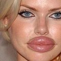 The Evolution of Dermal Fillers: A Look at the Last 40 Years
