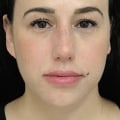 What is the Best Filler for Cheeks and Lips?