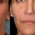 Do Dermal Fillers Make Skin Sag?