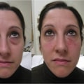 What Do Dermal Fillers Do to Your Face?