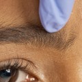 Are Fillers Injected Into the Muscle? An Expert's Perspective