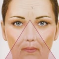 Where Should Cheek Fillers Go? A Comprehensive Guide