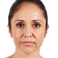 Why is Restylane More Expensive than Juvederm?