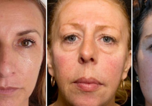 Can Fillers Make You Look Older?