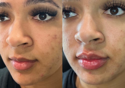 Curated Medical: The Home Of High-Quality Facial Fillers