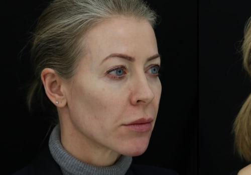 How Much Filler is Needed to Enhance Hollow Cheeks?