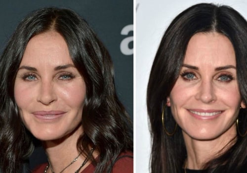 Can Fillers Mess Up Your Face? - A Comprehensive Guide