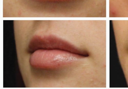 Do Lip Fillers Go Down After the First Day?