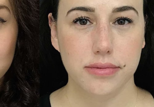What is the Best Filler for Cheeks and Lips?