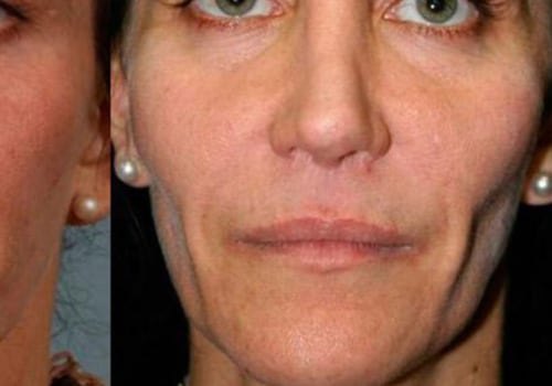 Do Fillers Cause Skin to Sag? - Dermal Filler Won't Do That