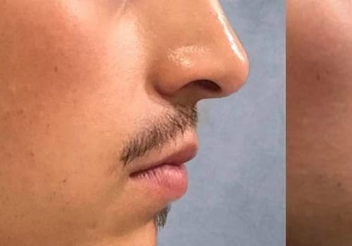Can Dermal Fillers Last Forever?