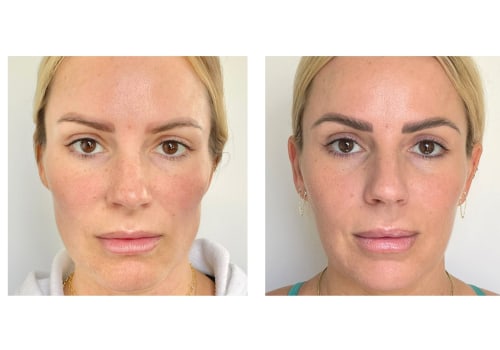 The Best Natural Fillers for a Youthful Look